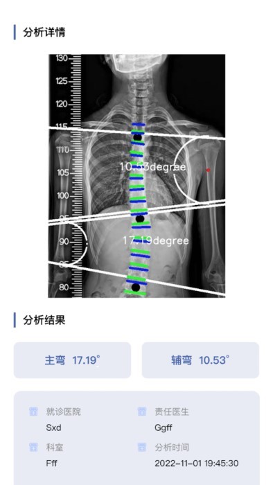 cobb角测量分析平台3